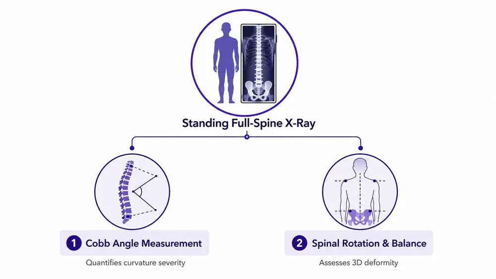 A diagram illustrating the scoliosis diagnosis process using a standing full-spine X-ray, Cobb angle, and spinal balance.