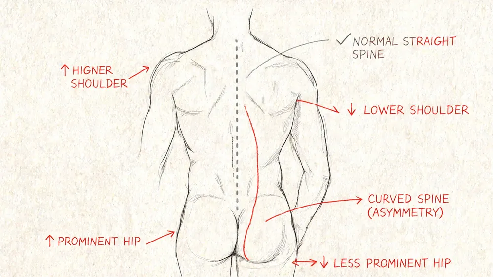 A diagram illustrating the postural asymmetry and physical symptoms associated with a curved spine or scoliosis.