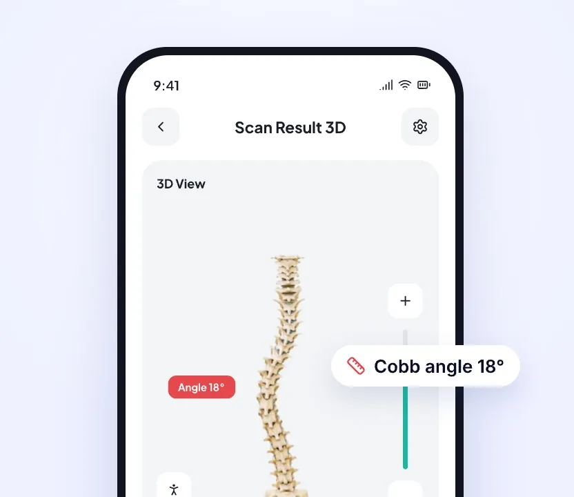 3D spine result showing the Cobb angle
