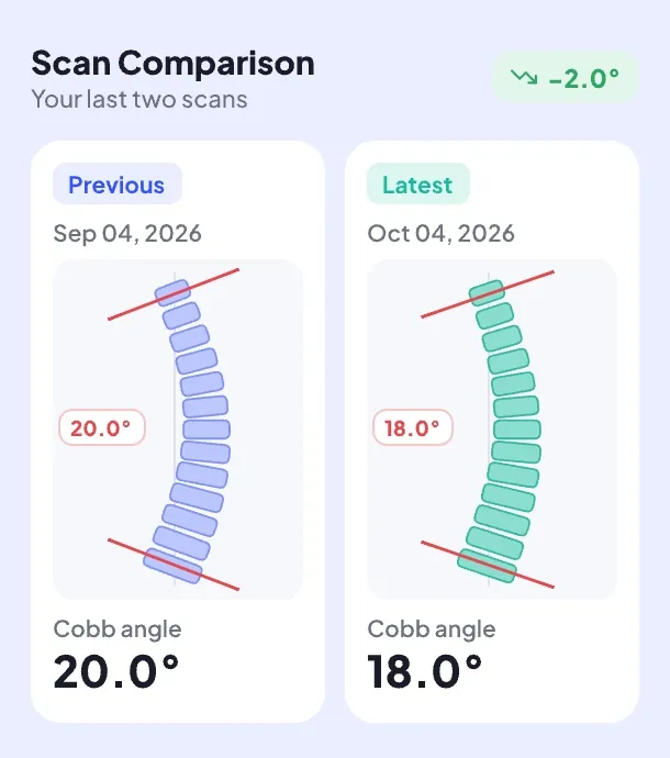 Scan comparison: previous scan at 20.0° Cobb angle, latest at 18.0°